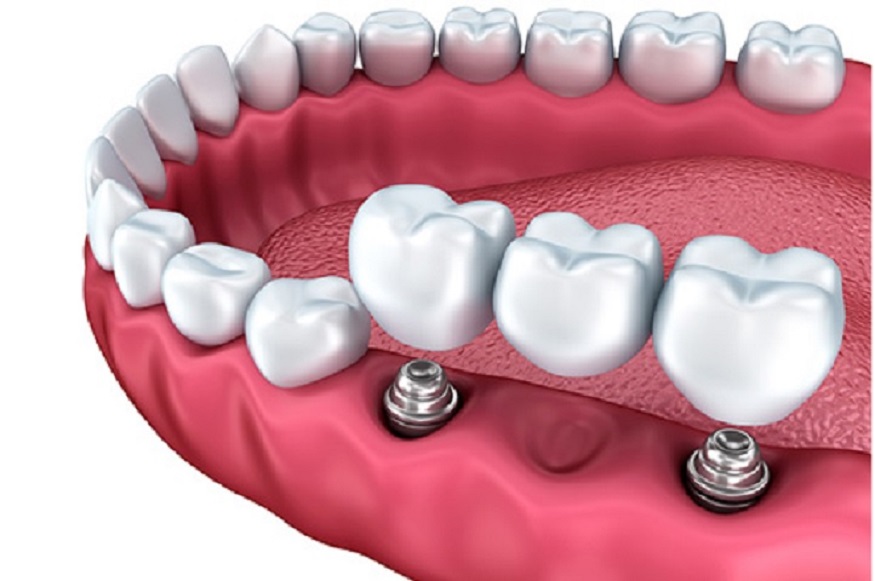 Dental Implants