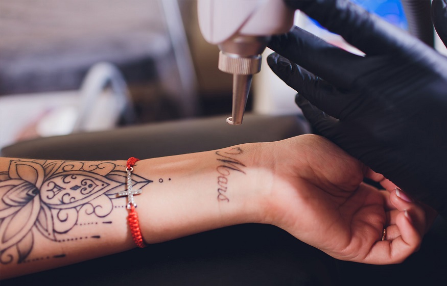Beginners guide to tattoo removal