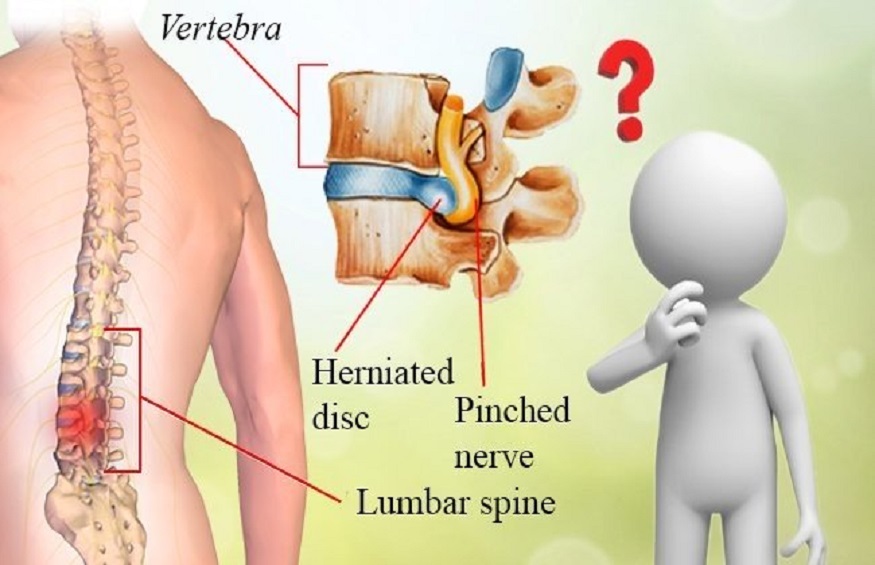 Slipped Discs Symptoms And Causes