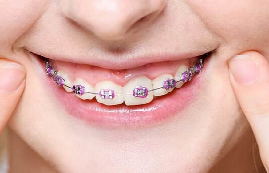 Types of Braces