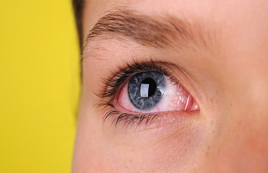 Symptoms And Causes Of Sore Eye